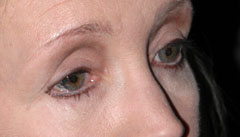 Revision Blepharoplasty - Patient 4 - Before